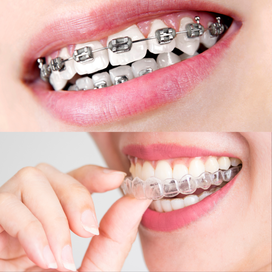 Braces comparison to Invisalign