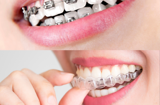 Braces comparison to Invisalign